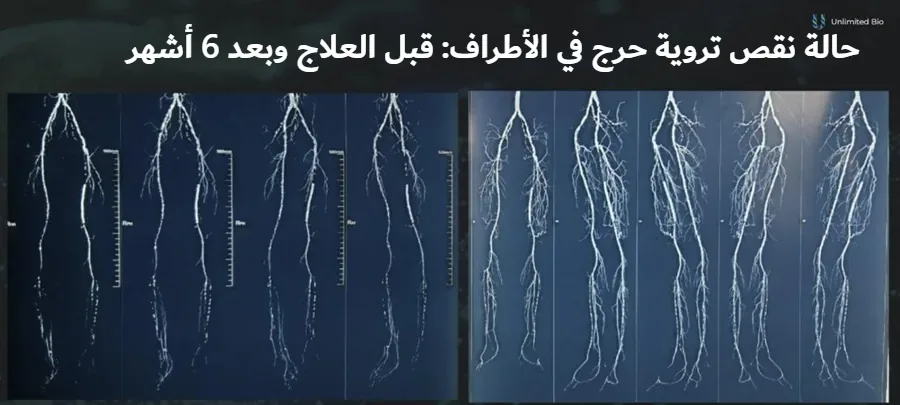 صور وعائية لساقَي مريض مصاب بنقص تروية حرج في الأطراف قبل العلاج الجيني بـ VEGF وبعده بـ 6 أشهر، تُظهر شبكة شعيرات دموية جديدة أكثف