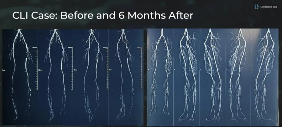 Angiograms of a critical limb ischemia patient's legs before and 6 months after VEGF gene therapy, showing a denser new capillary network