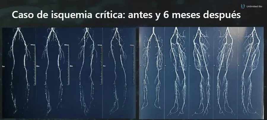 Angiografías de las piernas de un paciente con isquemia crítica de las extremidades antes y 6 meses después de la terapia génica VEGF, con una nueva red capilar más densa