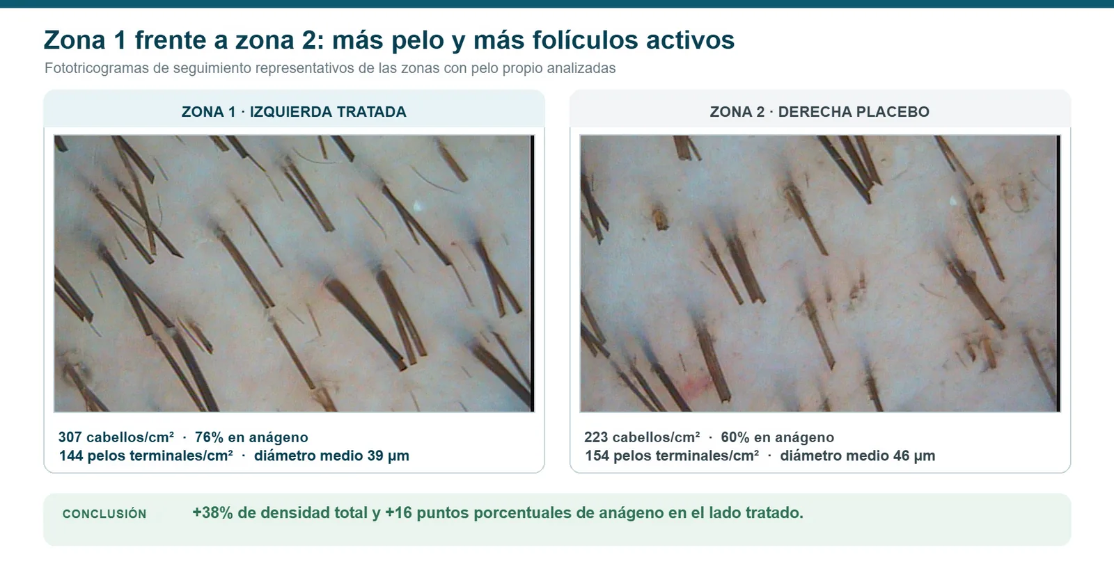 Fototricogramas de seguimiento del par temporoparietal: zona 1 tratada y zona 2 placebo