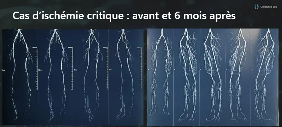 Angiographies des jambes d’un patient atteint d’ischémie critique des membres avant et 6 mois après une thérapie génique VEGF, montrant un nouveau réseau capillaire plus dense