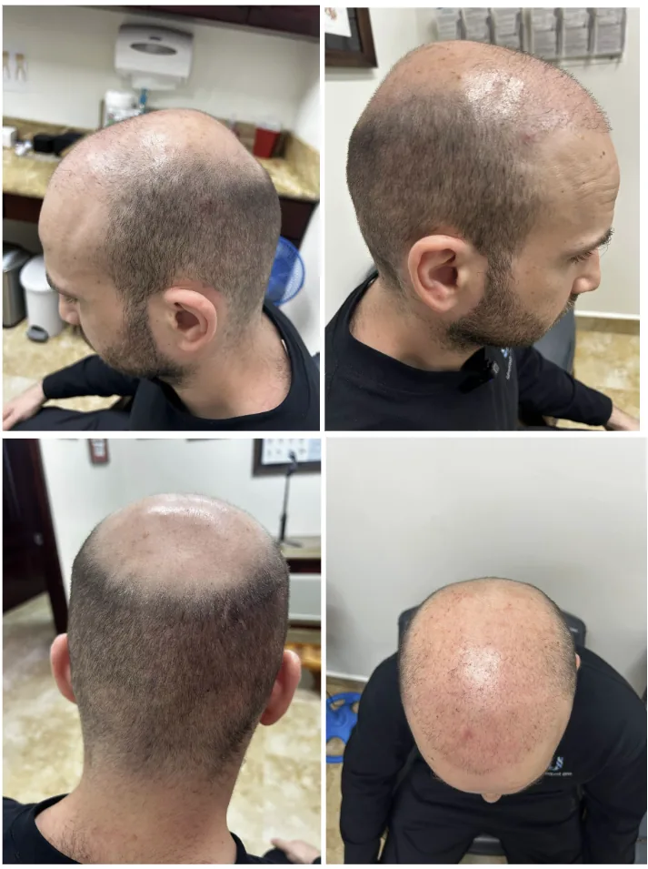 Four views of the scalp after the injections