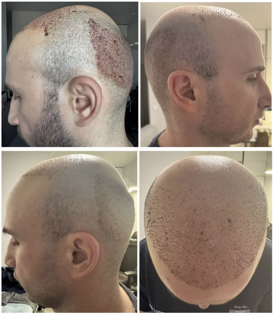 Four views of the scalp after the hair transplantation, with grafts placed