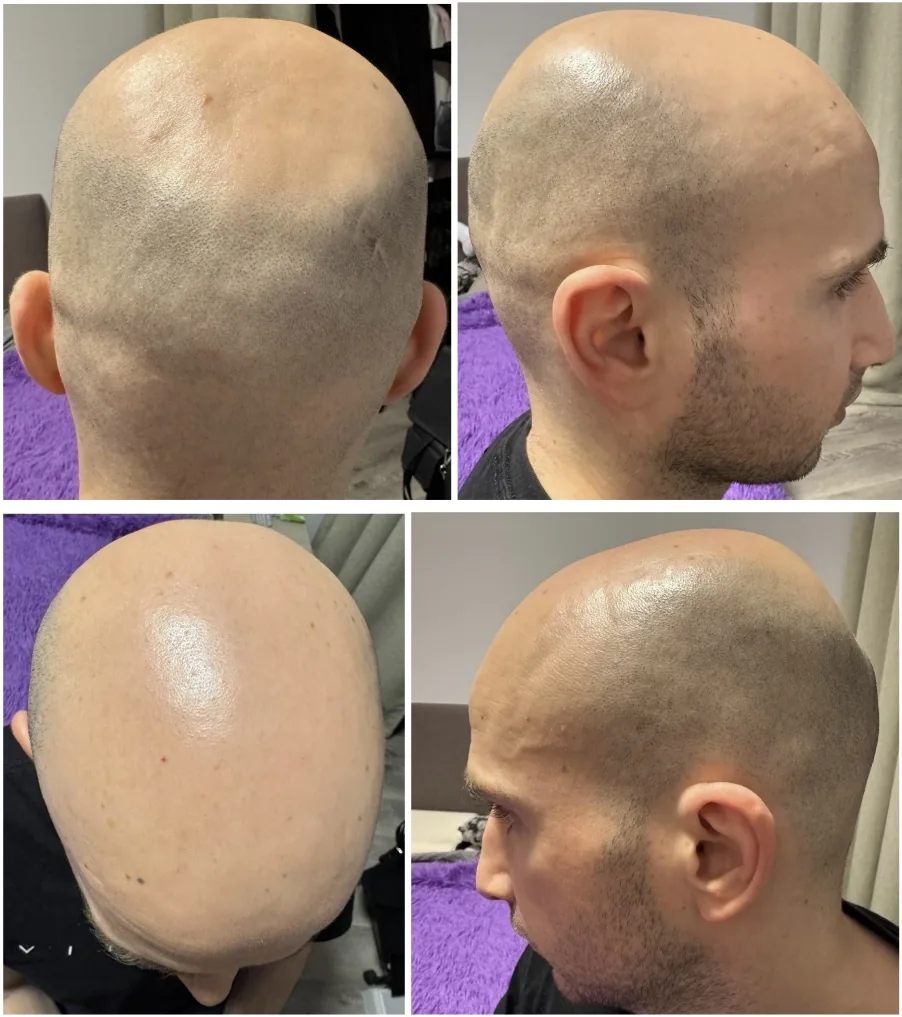Four views of the bald scalp before the injections and hair transplant