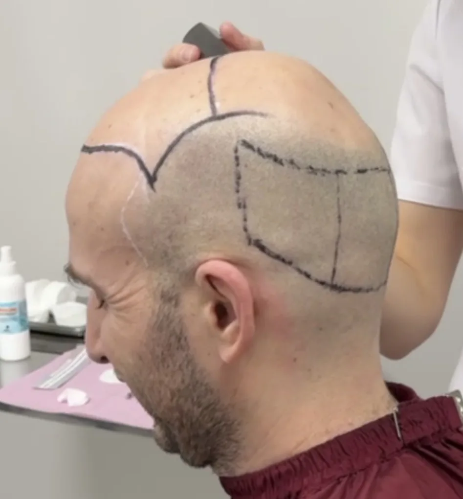 Scalp with the hair-transplant recipient zone and donor zone outlined in surgical marker