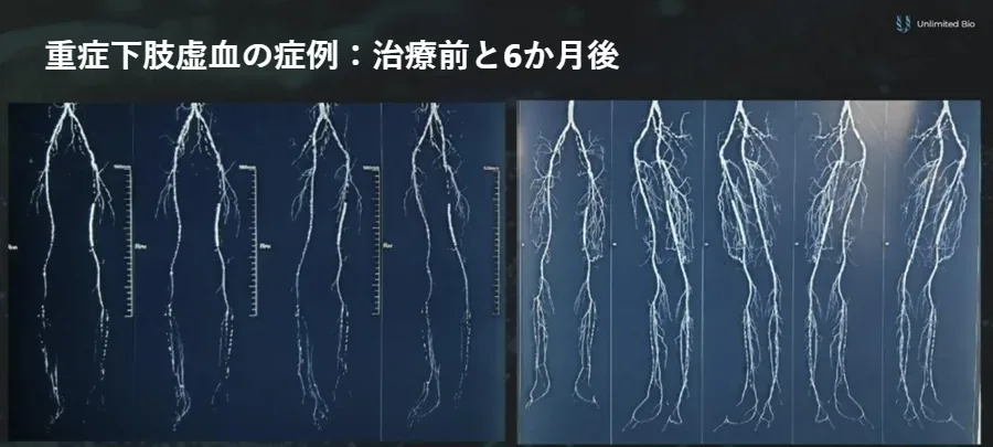重症下肢虚血の患者の脚の血管造影。VEGF遺伝子治療の前と6か月後で、より密な新しい毛細血管網が見られる