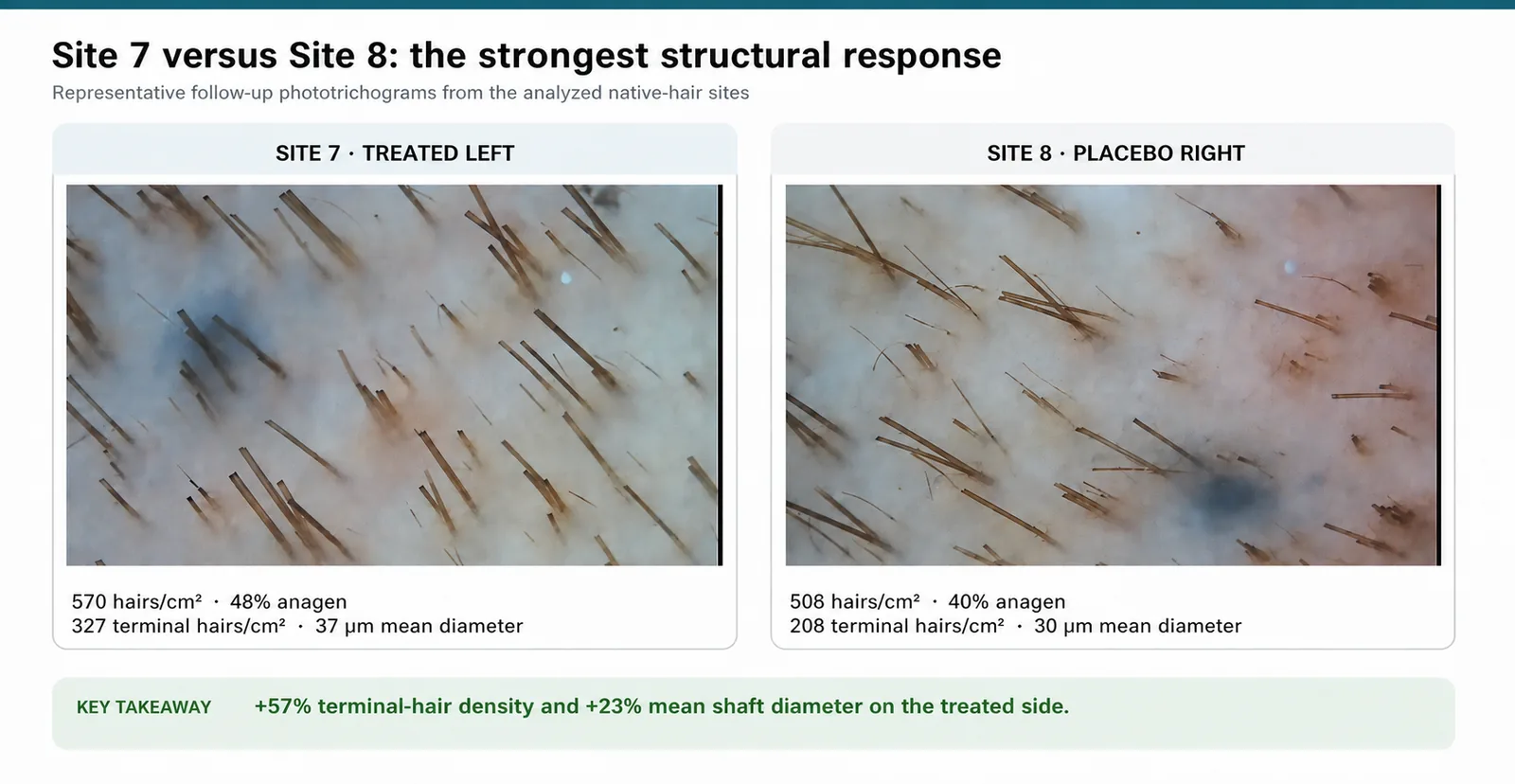 Follow-up phototrichograms of site 7, treated, and site 8, placebo: 570 versus 508 hairs per square centimetre and 37 versus 30 micrometre mean diameter