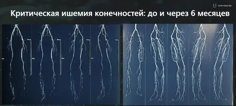 Ангиограммы ног пациента с критической ишемией конечностей до и через 6 месяцев после генной терапии VEGF: видна более плотная новая капиллярная сеть