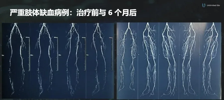 一名严重肢体缺血患者在 VEGF 基因疗法前和治疗 6 个月后的腿部血管造影,可见更密集的新生毛细血管网络
