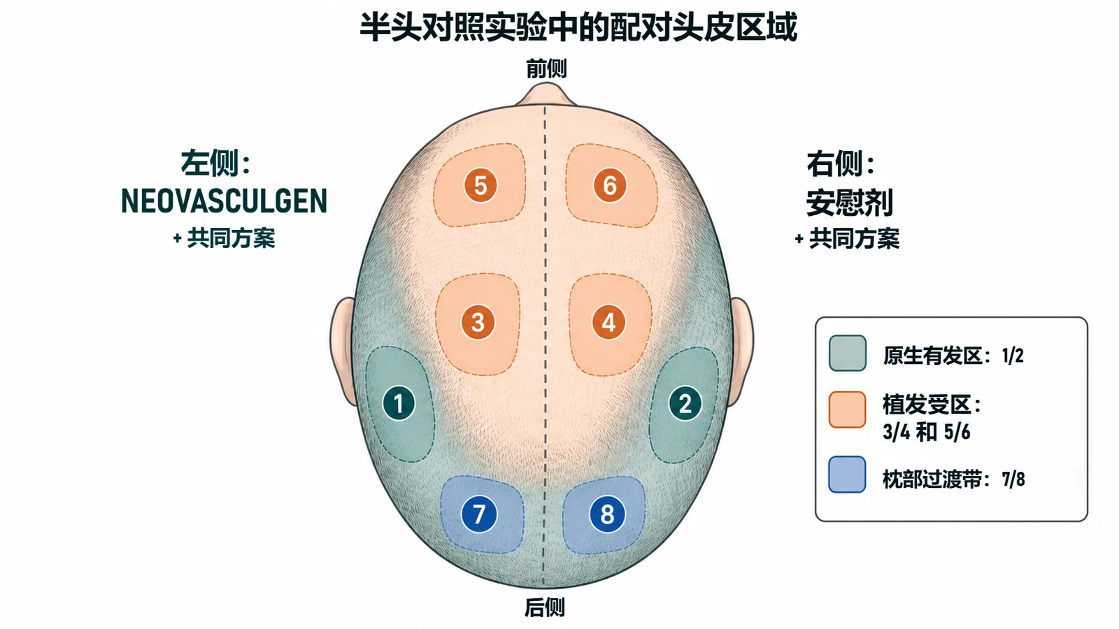 盲法半头对照实验的位点分布图：1 至 8 号配对头皮区域，左侧接受 Neovasculgen，右侧接受安慰剂