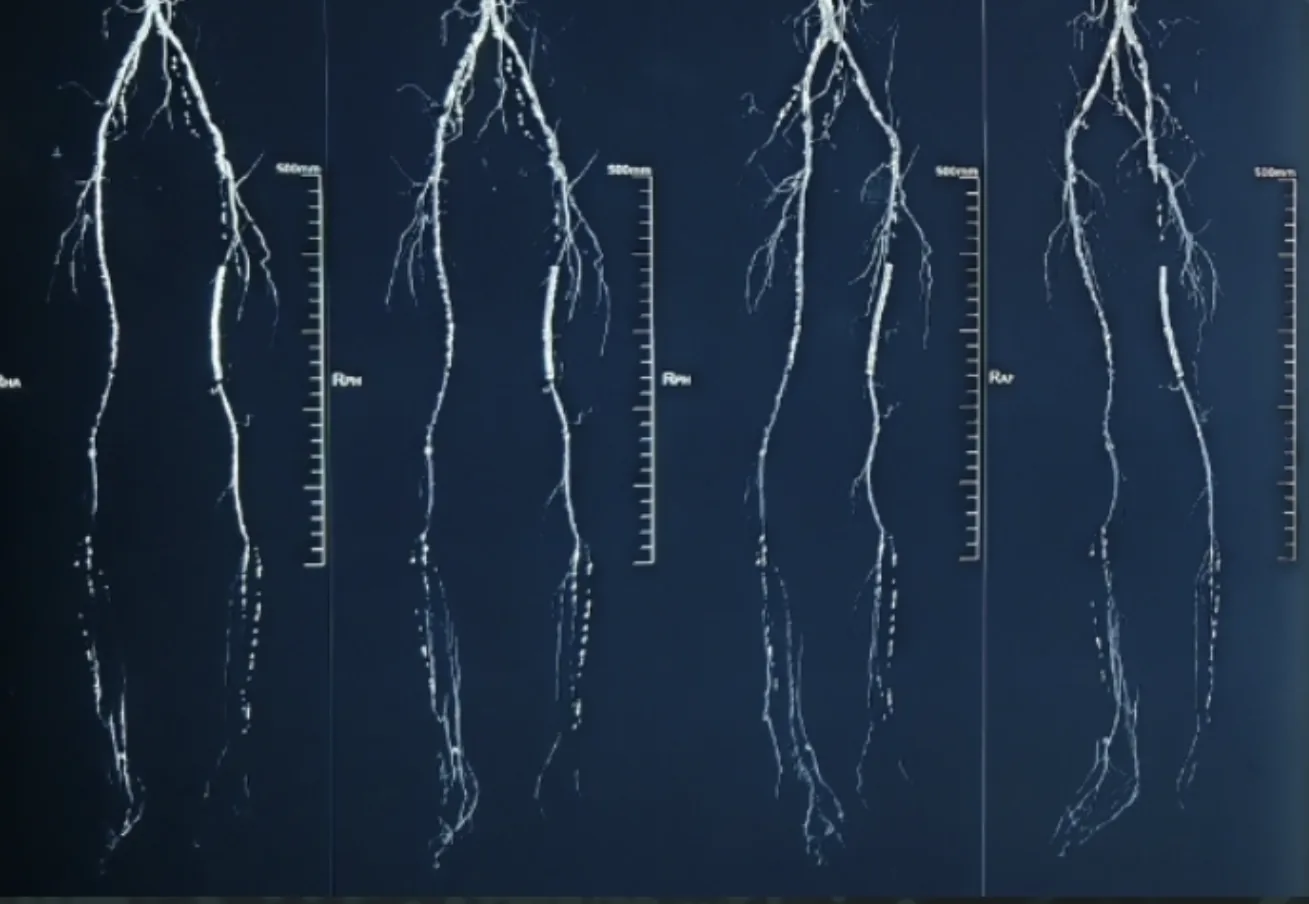 Angiogram of the patient's leg vasculature before VEGF treatment