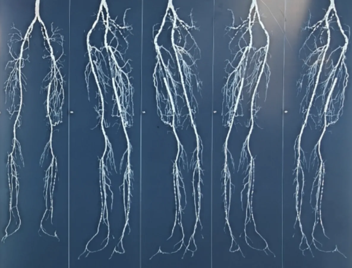 Angiogram of the patient's leg vasculature after VEGF revascularization, with scale bars