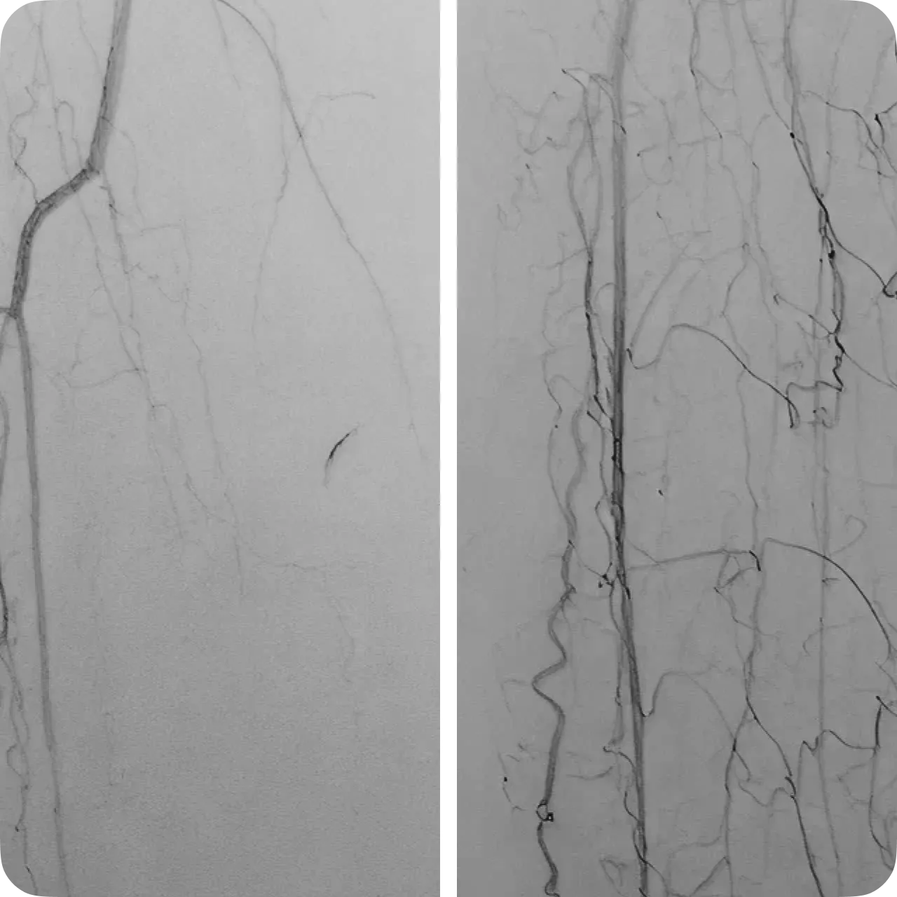Angiography before (left) and after (right) VEGF treatment