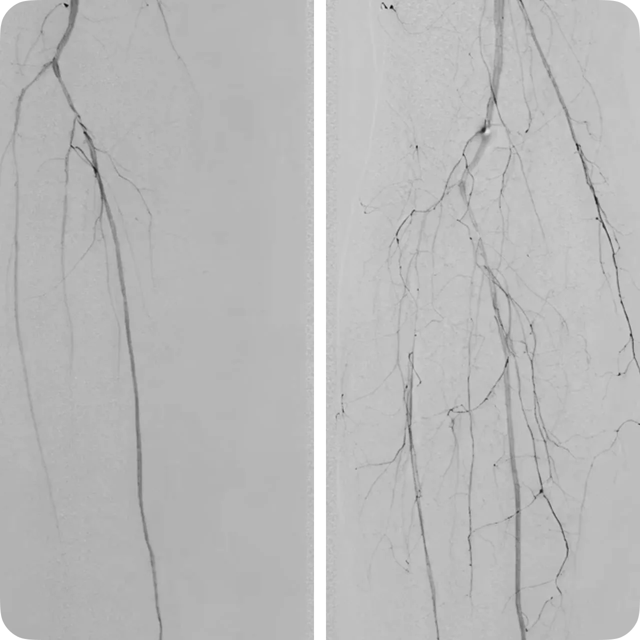 Angiography before (left) and after (right) VEGF treatment