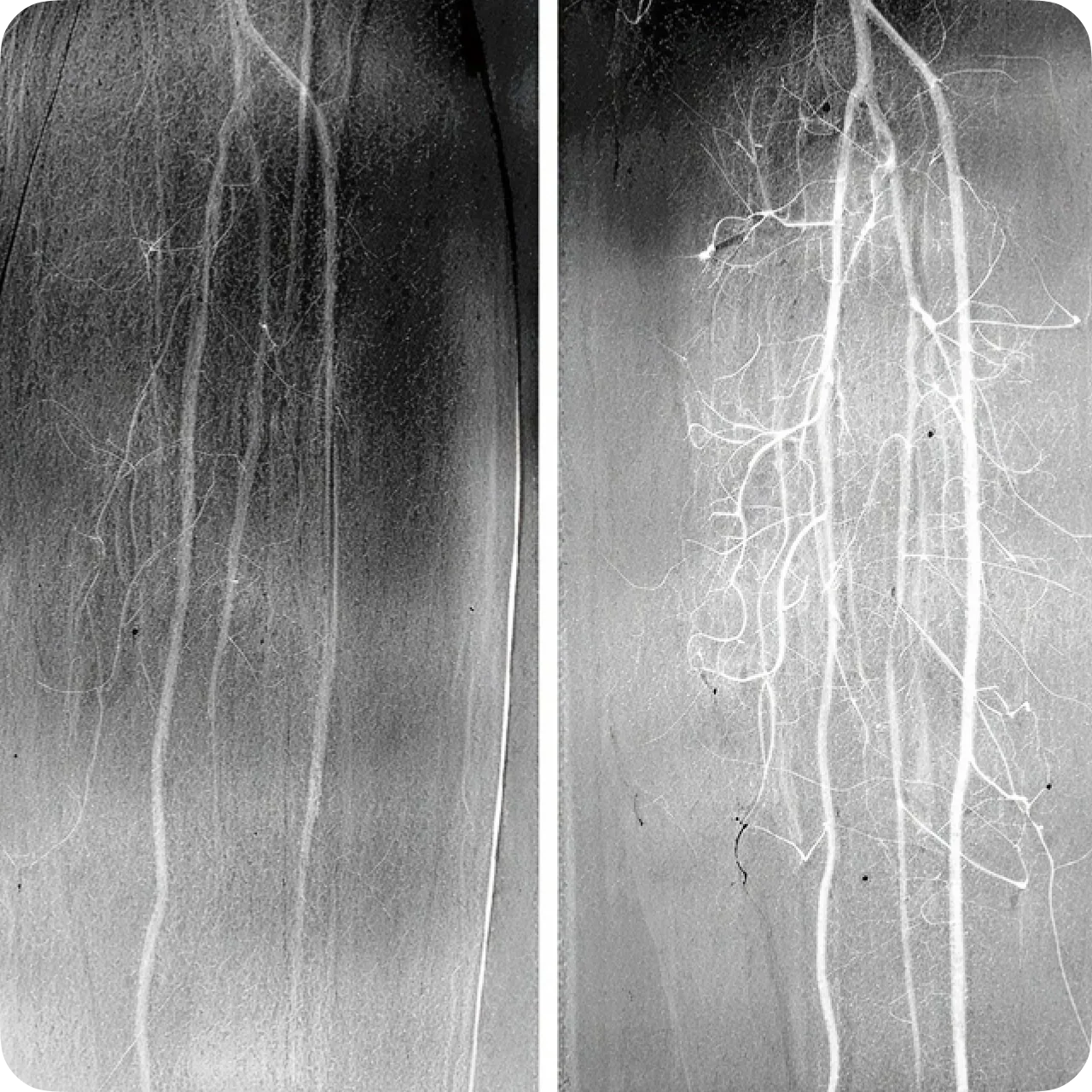 Angiography before (left) and after (right) VEGF treatment